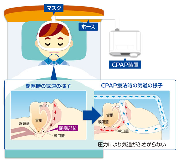 CPAP療法の役割